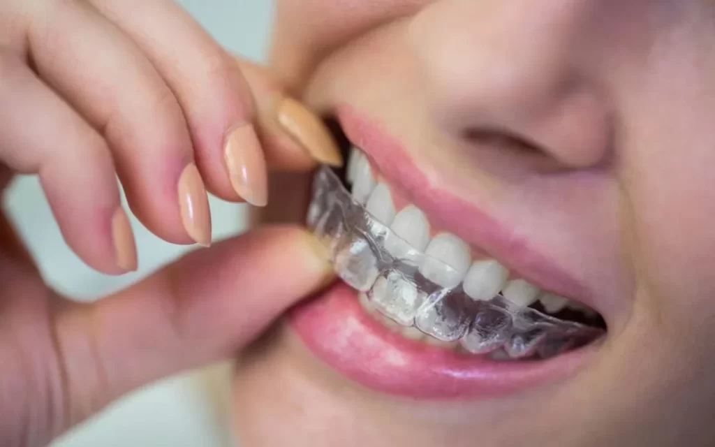Traditional Braces vs. Invisible Braces [Aligners]: Which One Should You Choose?